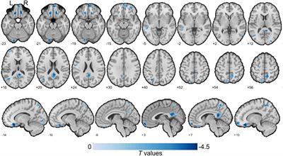 Hypertension With High Homocysteine Is Associated With Default Network Gray Matter Loss